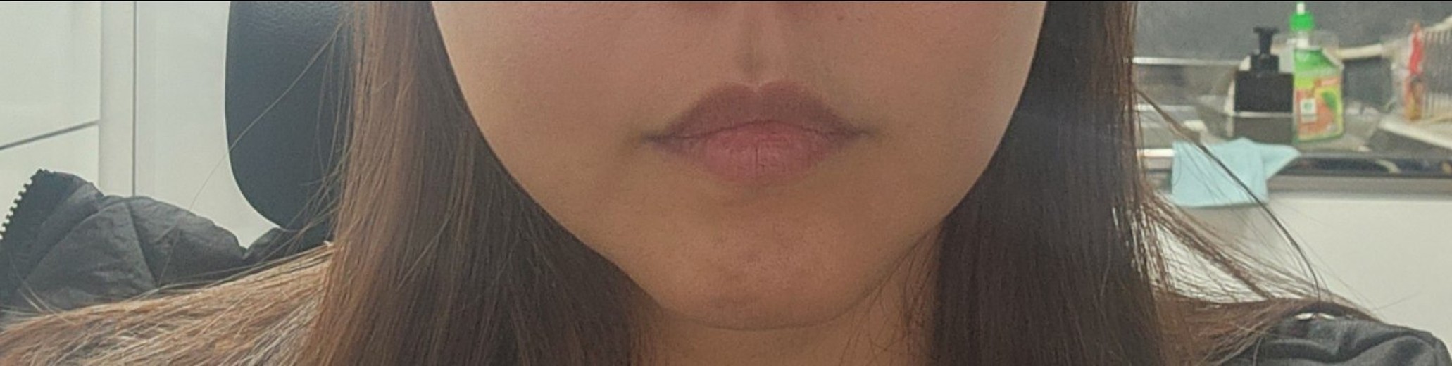 before photo: 턱끝보톡스, 턱끝필러