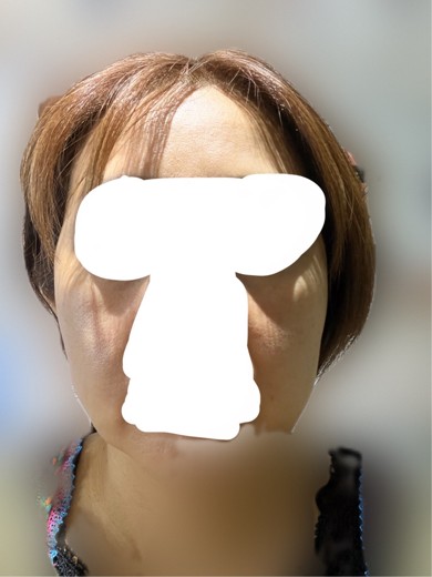 before photo: 脂肪溶解注射(顔)