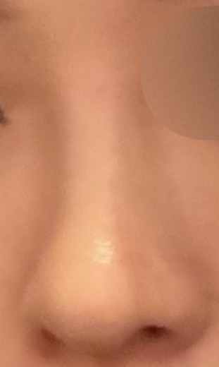after photo: 콧대(보형물), 코끝(자가연골)