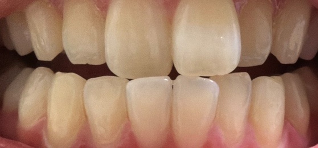 after photo: ホワイトニング