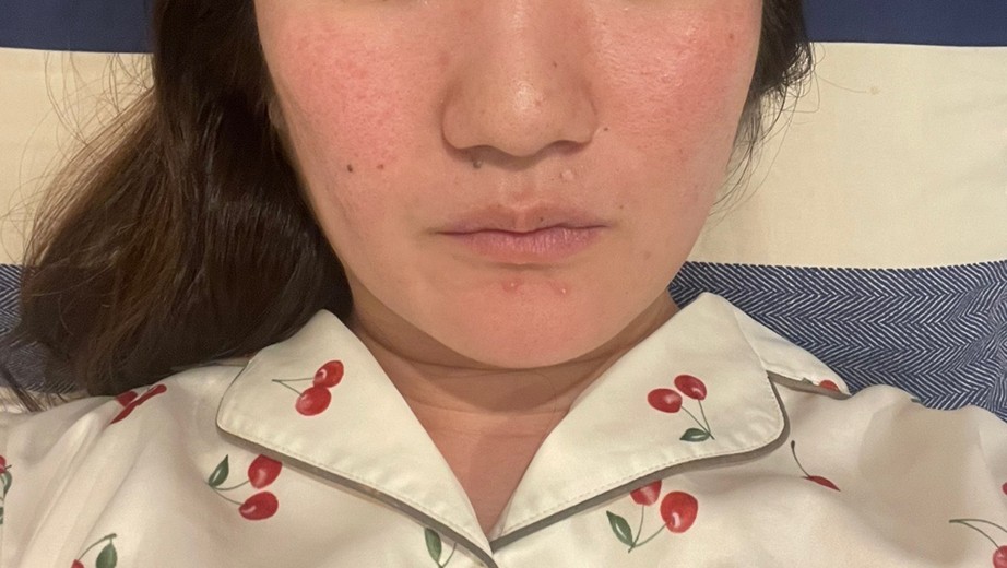 after photo: IPL(光/フォト治療)