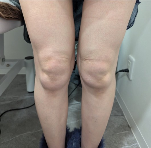 before photo: 脂肪溶解注射(太もも)