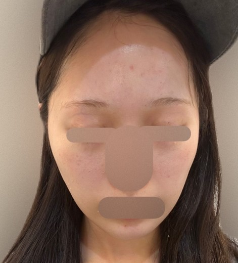 before photo: マッサージピール(コラーゲンピール)