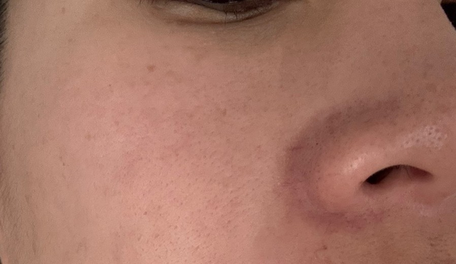 before photo: サーモン注射