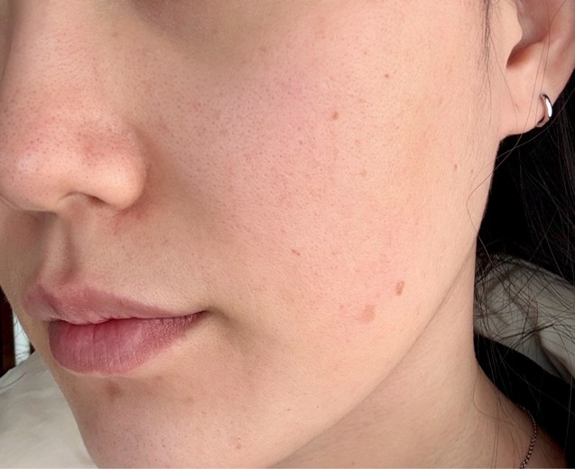 before photo: 리쥬란힐러