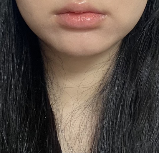 after photo: 윤곽주사