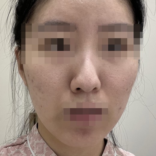 before photo: 코끝(자가연골)