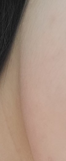 after photo: 윤곽주사