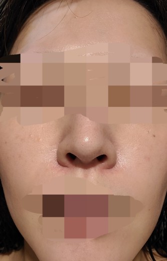 after photo: ハイドラフェイシャル, 診断・検査
