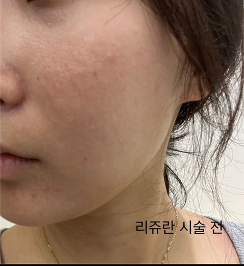 before photo: 리쥬란힐러