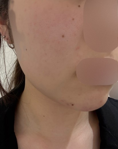 before photo: ピーリング