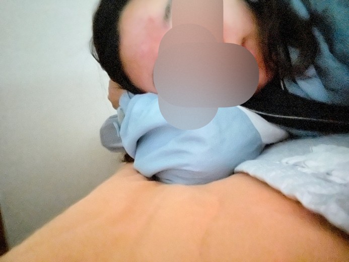 after photo: 여드름주사