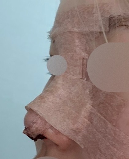 after photo: 비중격만곡증수술, 콧대(보형물), 코끝(자가연골)