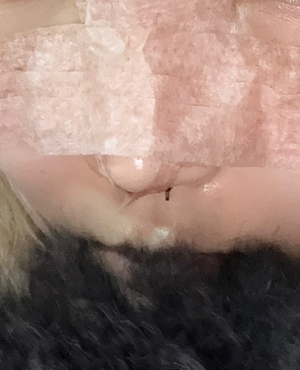 after photo: 비중격만곡증수술, 콧대(보형물), 코끝(자가연골)