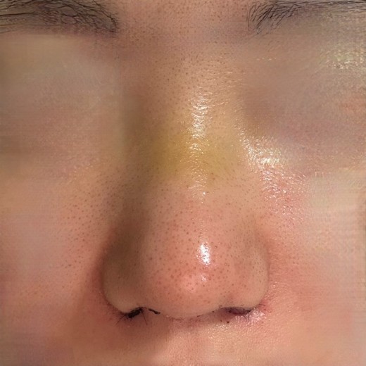 after photo: 콧볼축소, 복코교정(수술)