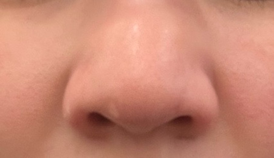 after photo: 脂肪溶解注射(顔)