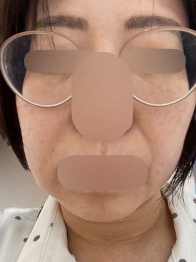 after photo: ショッピングリフト(ショートスレッド)