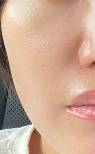 after photo: 白玉注射・点滴