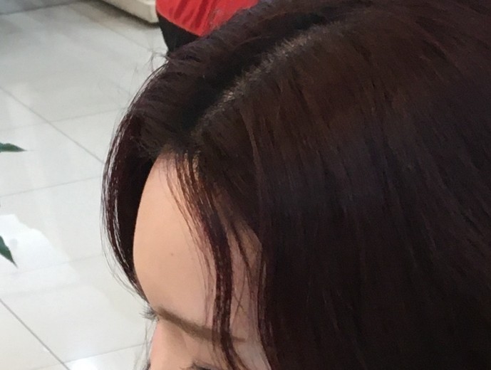 after photo: 이마필러