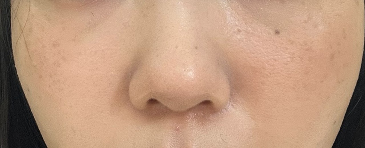 after photo: IPL(光/フォト治療), 診断・検査