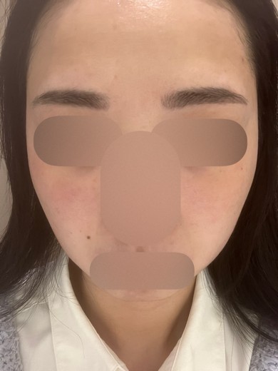 after photo: 白玉注射・点滴, ルメッカ