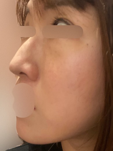 after photo: フラクショナルレーザー, ピコトーニング, 診断・検査