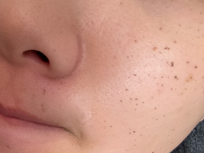 after photo: IPL(光/フォト治療), 診断・検査