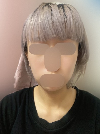 after photo: 首・広頚筋ボトックス