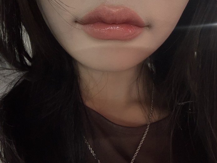 after photo: 실리프팅