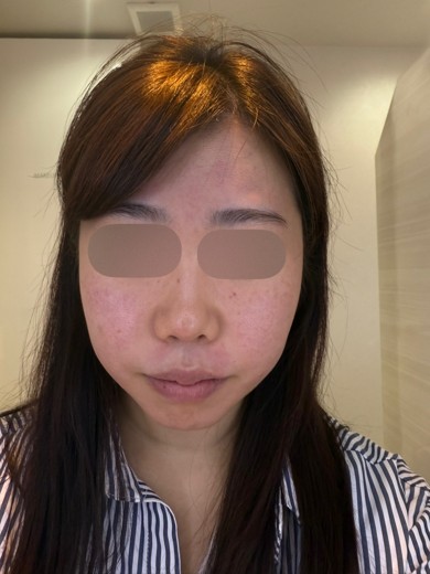 after photo: IPL(光/フォト治療), ルメッカ