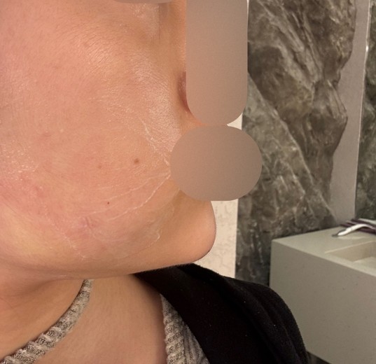 after photo: 턱끝필러