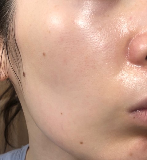 after photo: エレクトロポレーション