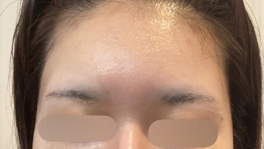 before photo: 額ヒアルロン酸