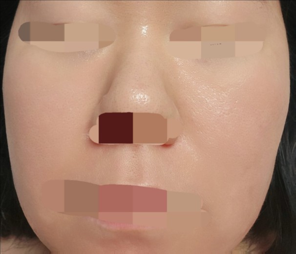 after photo: 아쿠아필링