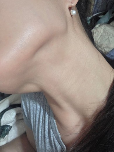 after photo: 침샘보톡스