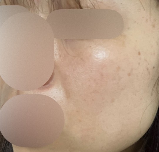 after photo: レーザートーニング, 診断・検査