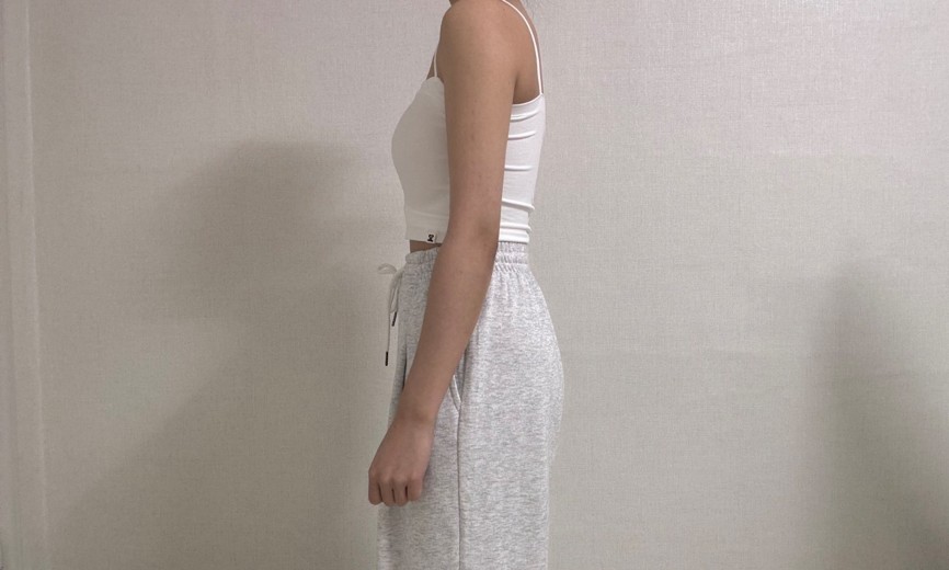 after photo: 팔지방흡입, 부유방흡입