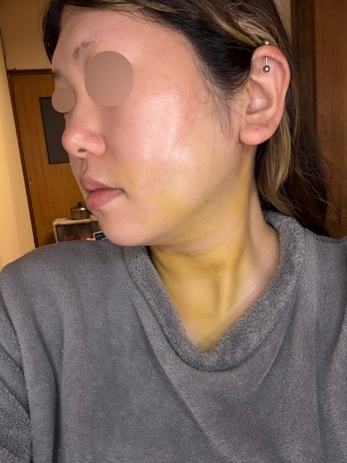 after photo: 糸リフト, 脂肪吸引(顎下), 脂肪吸引(顔), 脂肪吸引(頬)