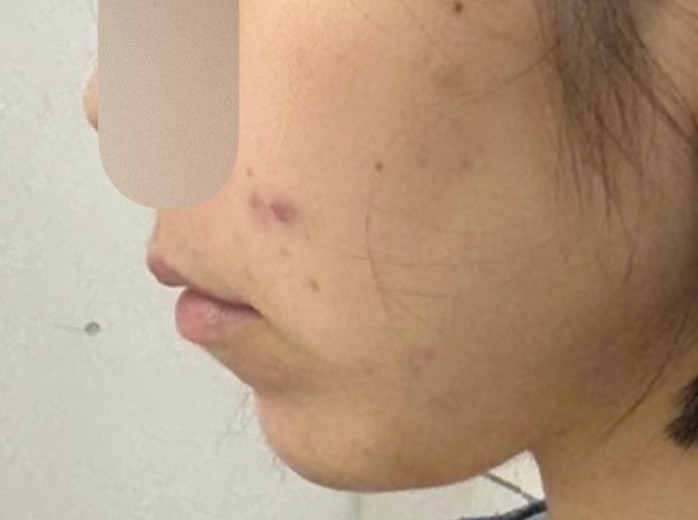 before photo: 턱끝필러