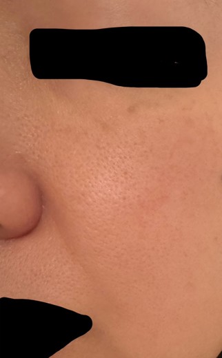 before photo: ピコトーニング, ハイドラフェイシャル, ピコフラクショナル, イオン導入