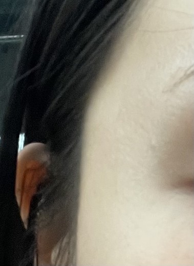 after photo: 사각턱보톡스