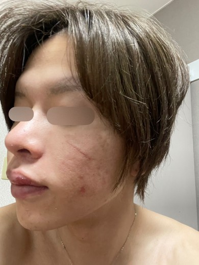 before photo: ダーマペン