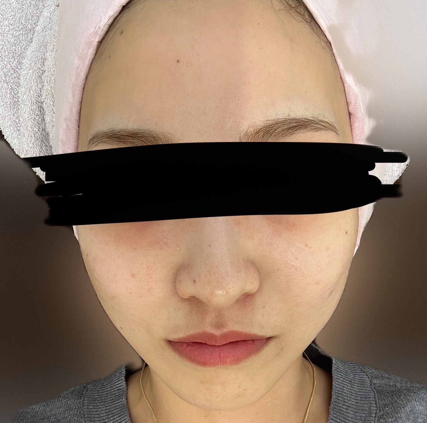 コラーゲンピールの施術・口コミ・クリニック情報(2026) | カンナムオンニ