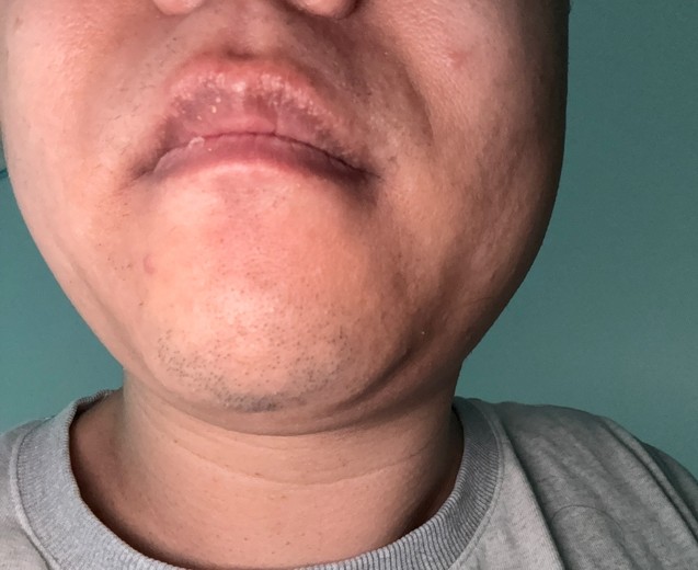 after photo: 턱제모, 인중제모