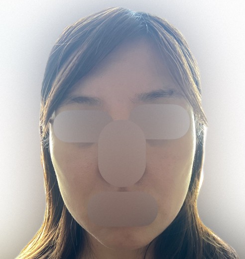 after photo: IPL(光/フォト治療)