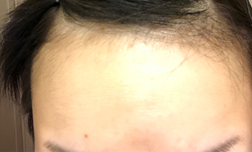 before photo: マッサージピール(コラーゲンピール)