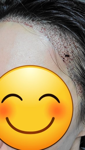 after photo: 머리모발이식