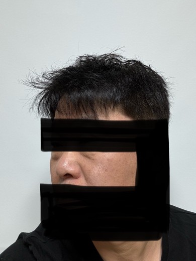 before photo: 눈밑지방재배치