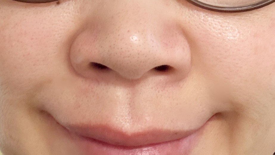 after photo: 小鼻ボトックス, 鼻先ボトックス