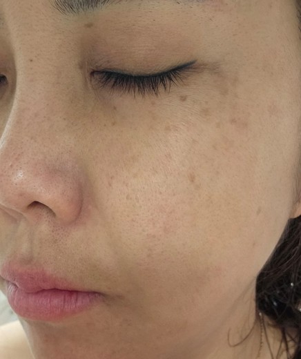 before photo: 점제거시술, V레이저